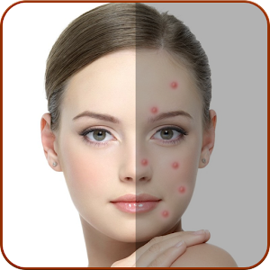 Acne Remover - Pimple Remover icon